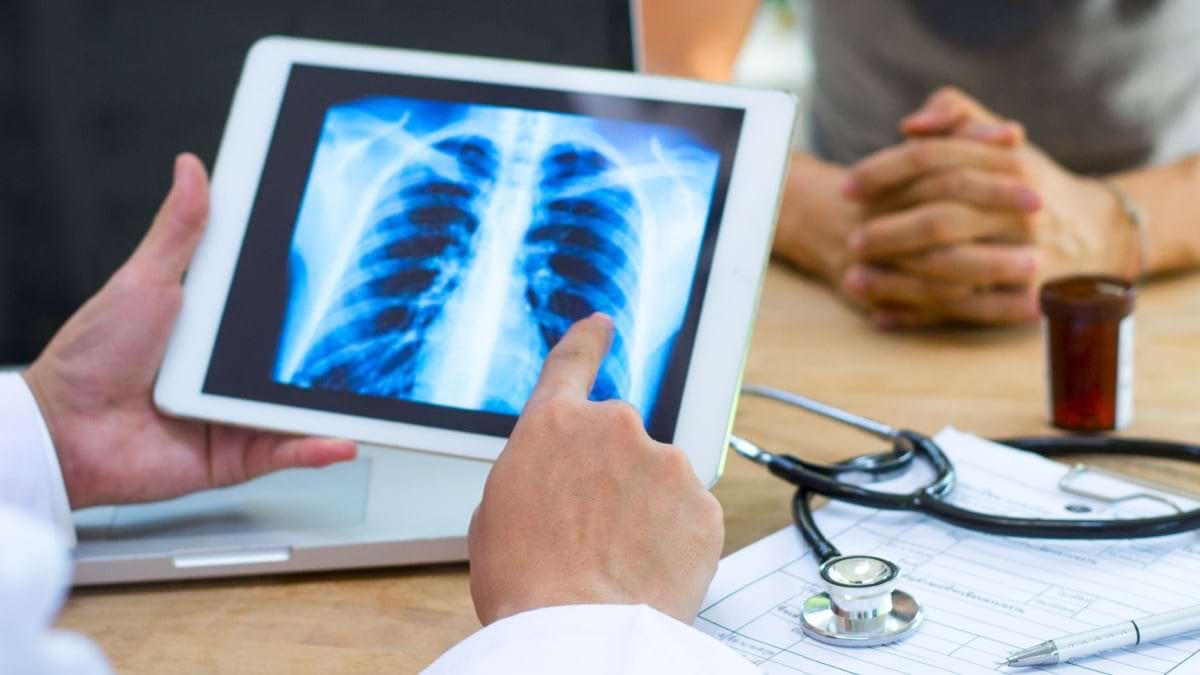 Tumorile pulmonare carcionoide