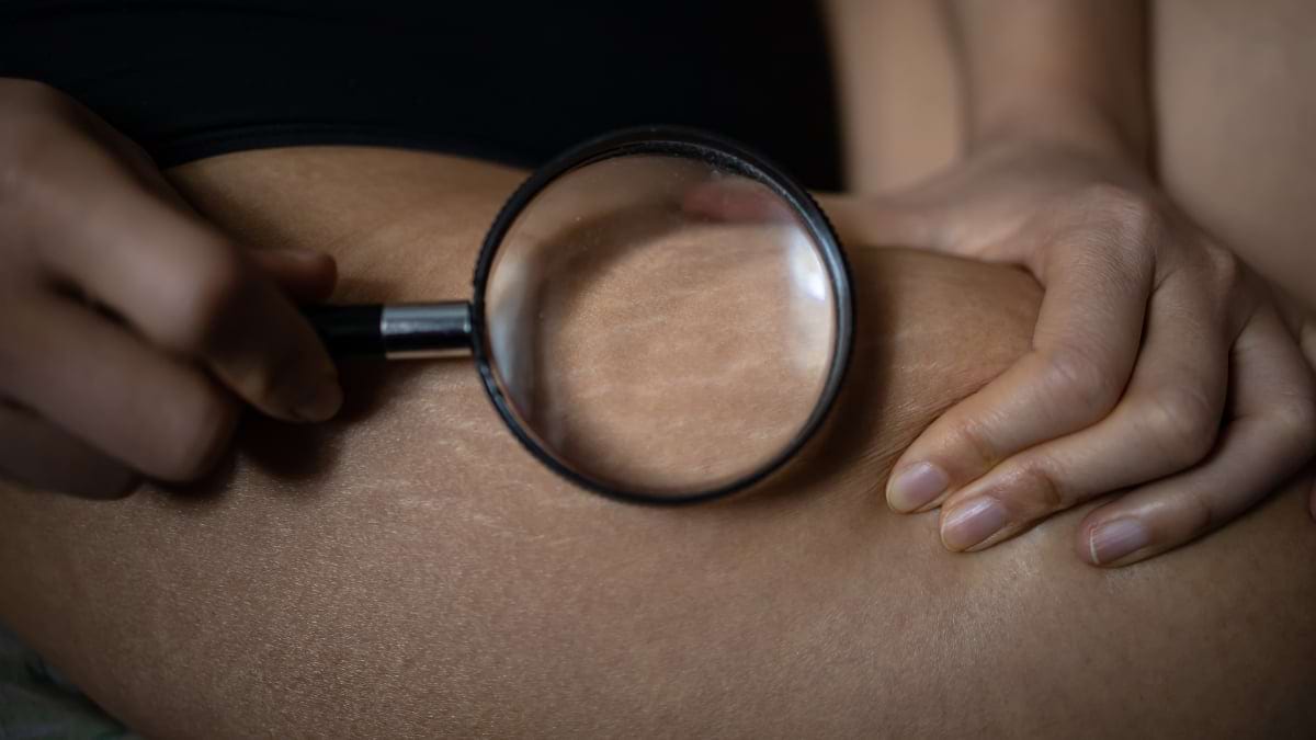 Remedii naturale pentru vergeturi, cu ingrediente la indemana