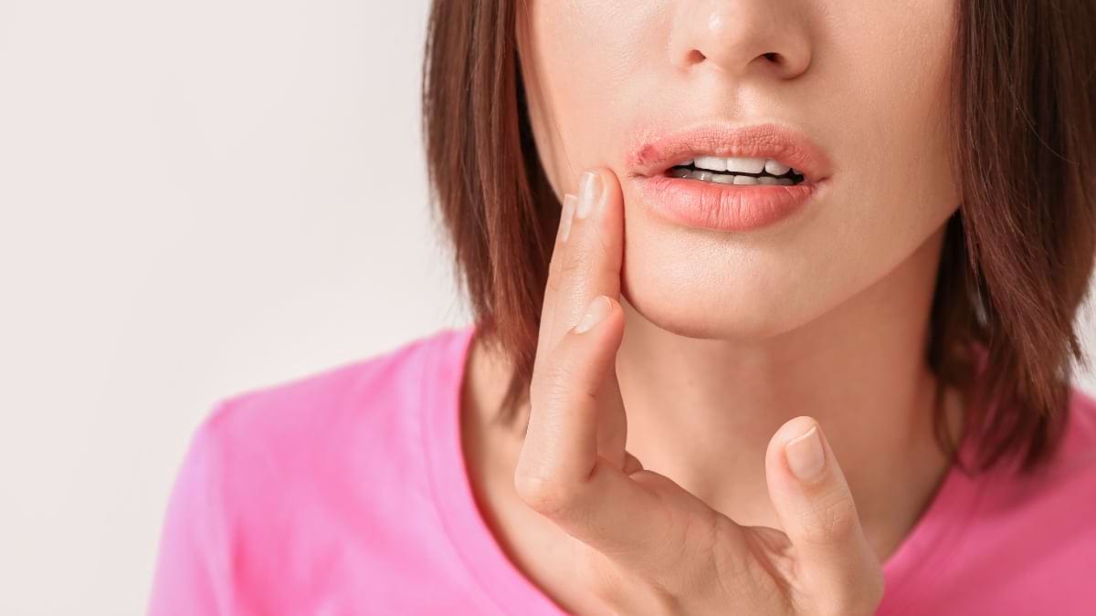 Cum tratezi corect herpesul? Antivirale și remedii naturale