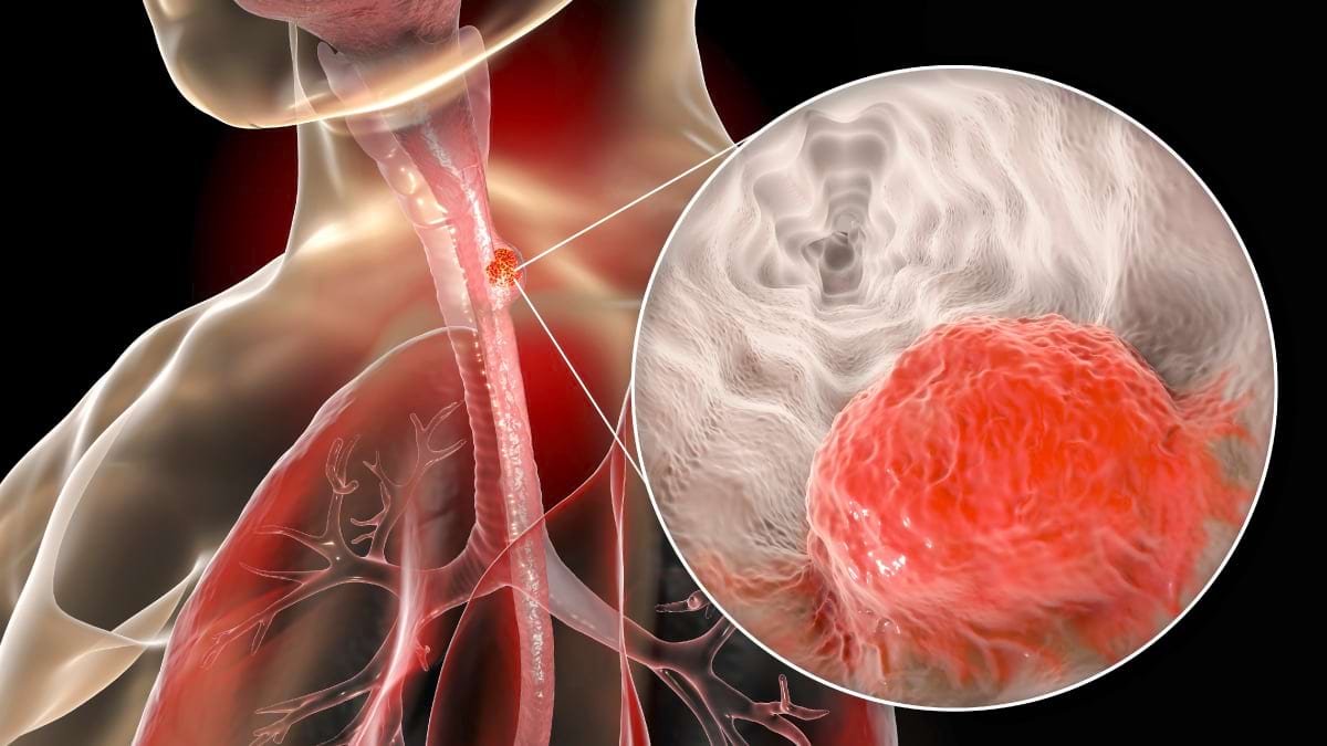 Cancerul esofagian, locul sase in lume in topul mortalitatii prin cancer
