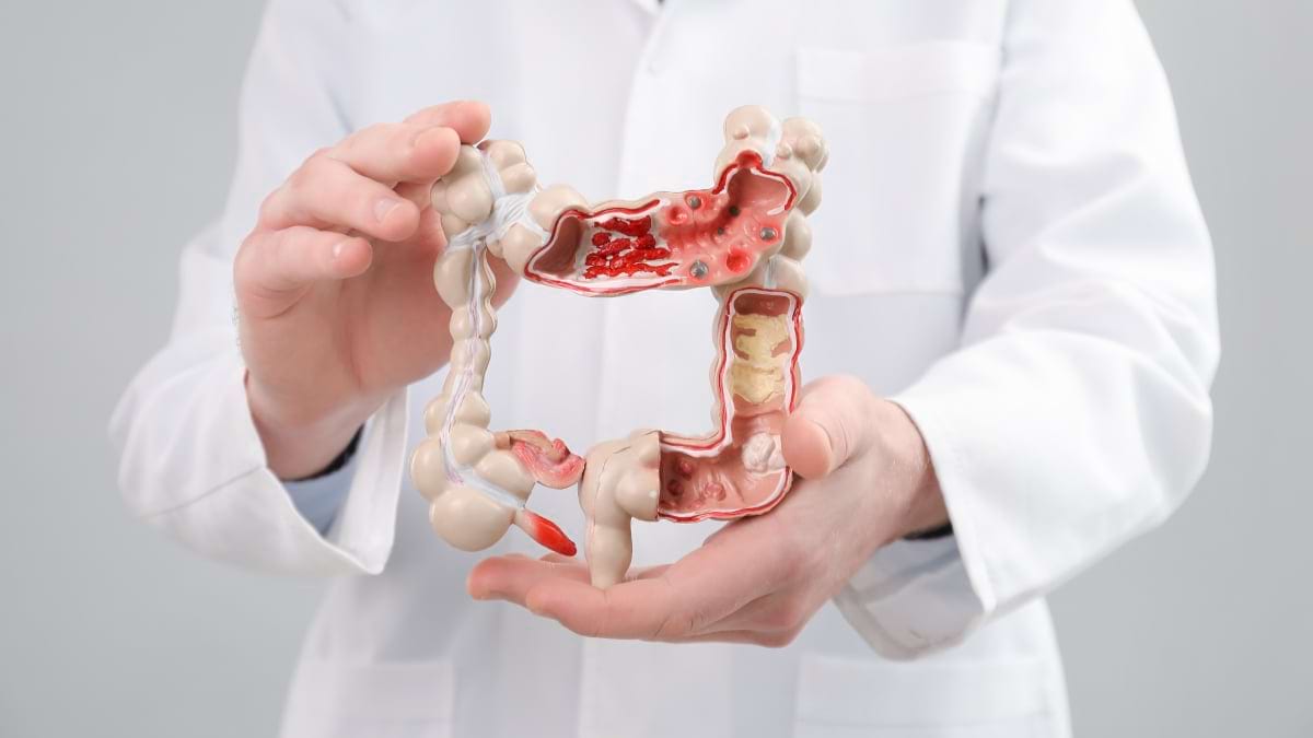 Știi ce simptome are un infarct intestinal?