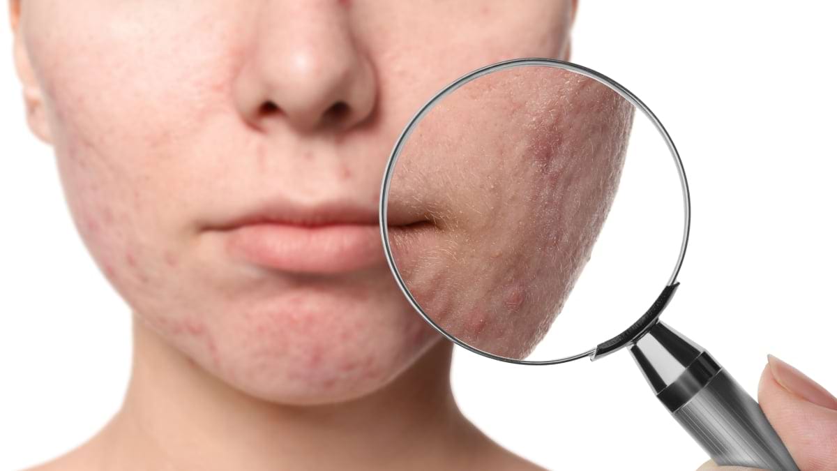 5 obiceiuri care contribuie la cicatricile aparute dupa acnee
