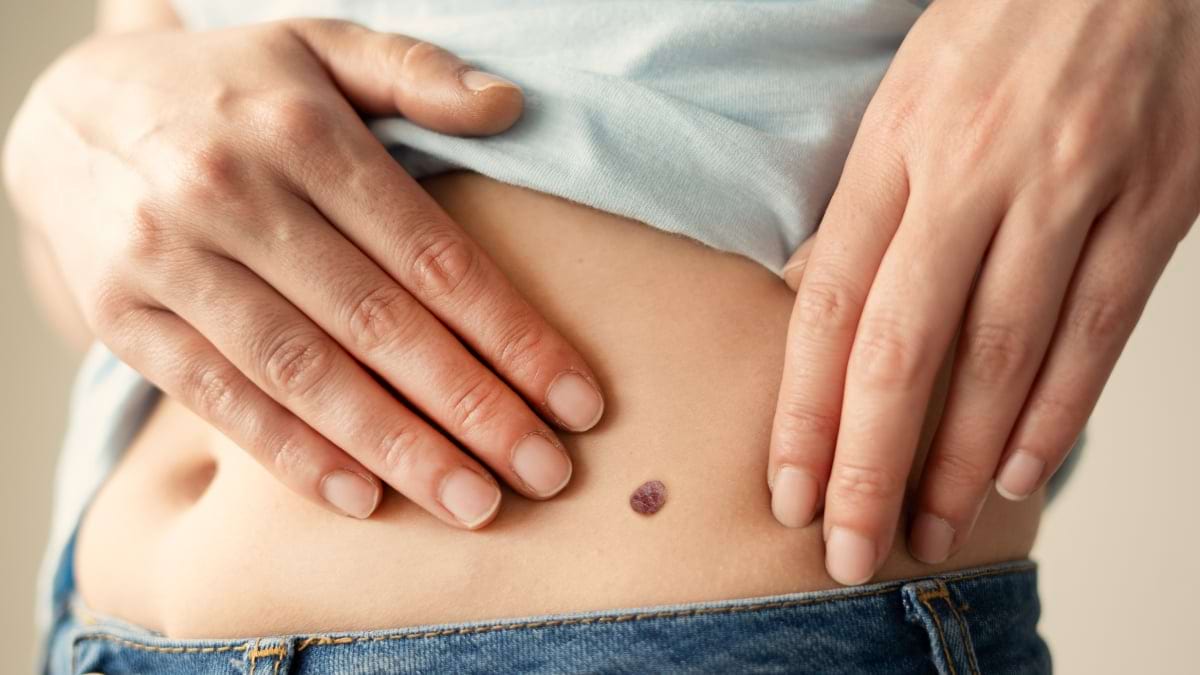 Autoexaminarea aluniţelor – efectuarea corectă ne poate salva viaţa