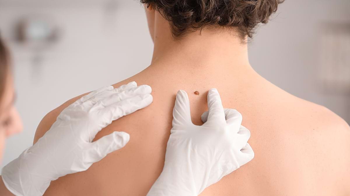 Bărbații, mai expuși melanomului decât femeile