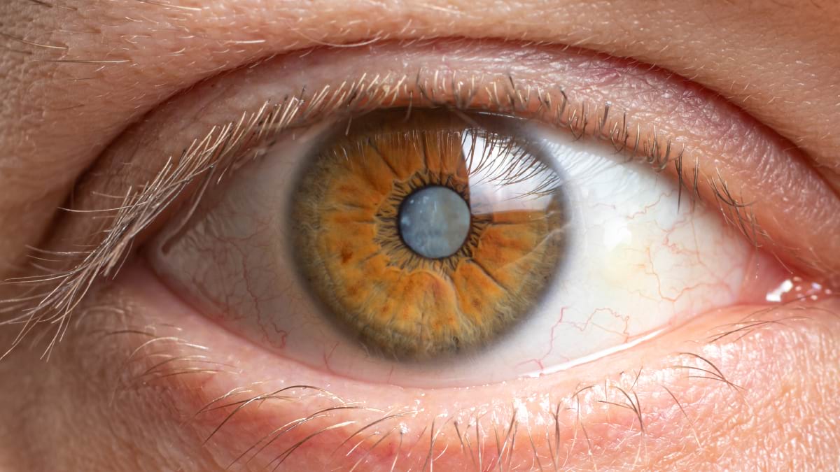 De ce apare cataracta la pacientii mai tineri?