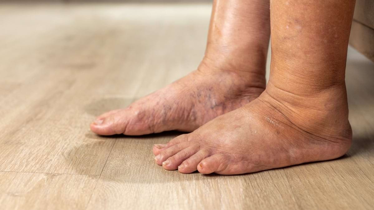 Picior diabetic: cauze, simptome, tratament
